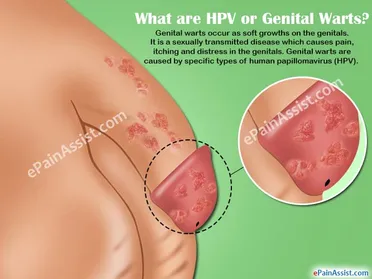 Symptoms of genital warts.seo